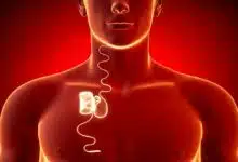 L'invention d'un implant pour traiter efficacement l'apnée du sommeil.